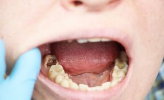 5 Tips To Prevent Tooth Decay: Cavities Treatment Nerul