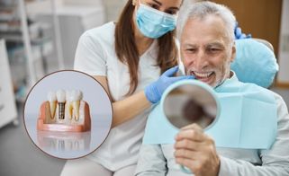 6 Long-Term Benefits of Dental Implants for Teeth Replacement