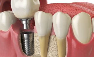 Dental Implants Process