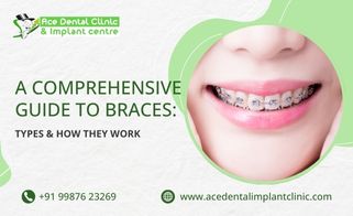 A Comprehensive Guide to Braces: Types & How They Work