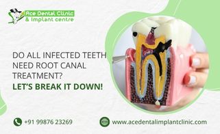 Do All Infected Teeth Need Root Canal Treatment? Let’s Break It Down