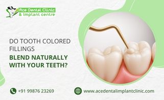Do Tooth Colored Fillings Blend Naturally with Your Teeth?