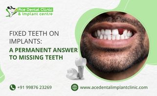 Fixed Teeth on Implants: A Permanent Answer to Missing Teeth