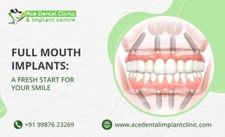 Full Mouth Implants: A Fresh Start for Your Smile