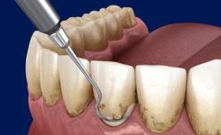 What is Scaling and Polishing?