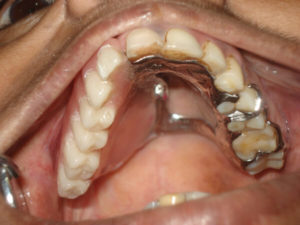 Maxillofacial prosthesis after