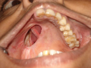 Maxillofacial prosthesis before